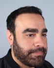 After Hair Transplant&nbsp;2 Sessions (Areas)